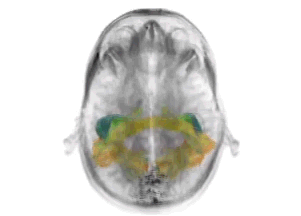 Altered White Matter in Early Visual Pathways of Humans with Amblyopia
