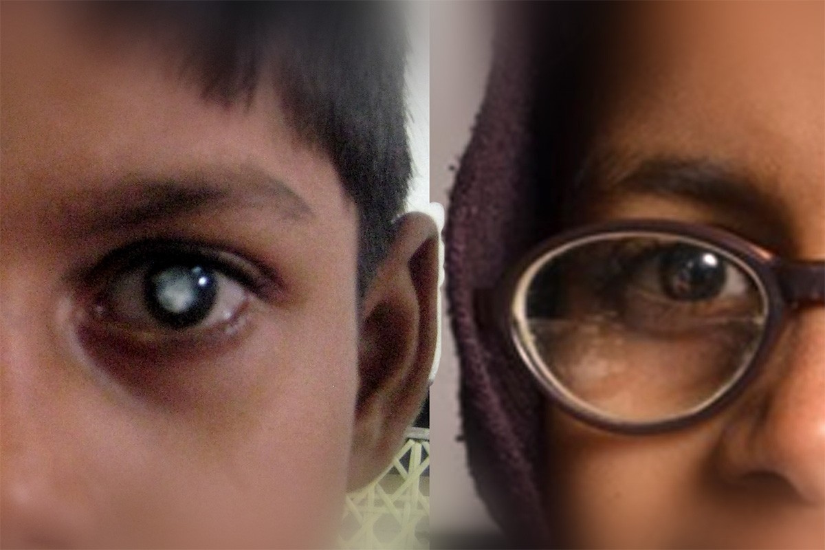  Anonymized photographs of two adolescent congenital cataract patients from Uttar Pradesh.